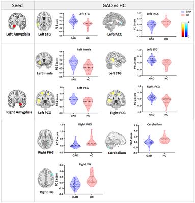 Illness Severity Moderated Association Between Trait Anxiety and Amygdala-Based Functional Connectivity in Generalized Anxiety Disorder